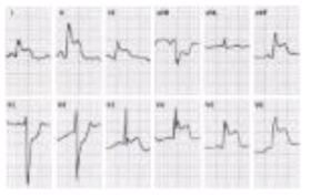 ECG gram