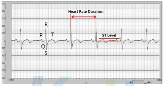 ECG 측정 결과 분석