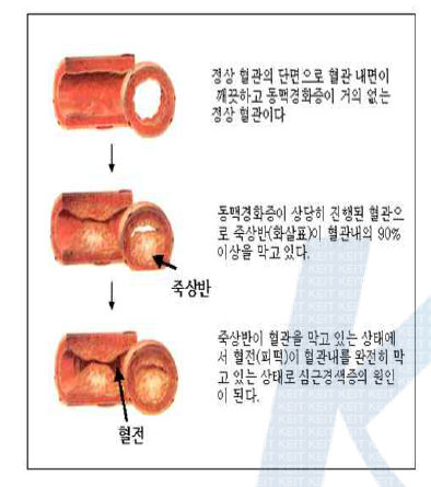 관상동맥질환 모식도