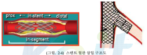 스텐트 혈관 삽입 구조도