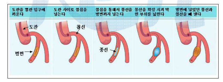 관상동맥확장성형술의 방법