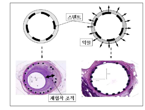 일반스텐트와 약물스텐트의 비교