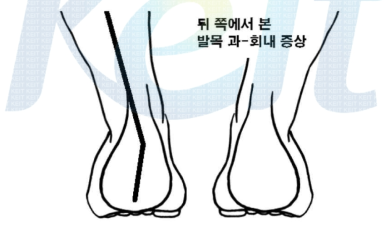 Posterior view of the ankle over-pronation