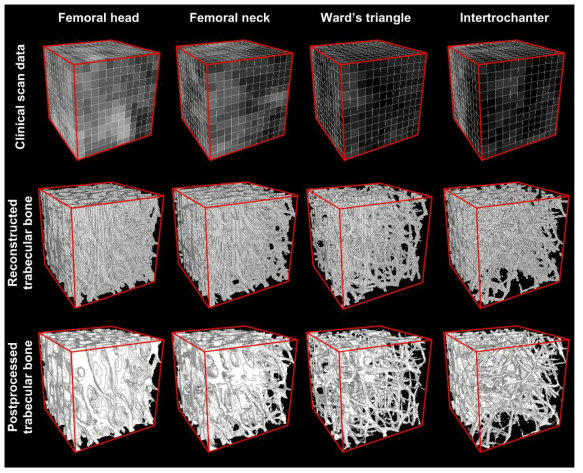 Comparison of the CT scan data (62-year-old female with no metabolic bone disorder), the reconstructed trabecular bone, and the post-processed trabecular bone for the four VOIs. The reconstructed trabecular bone was post processed by ImageJ for clearer visualization