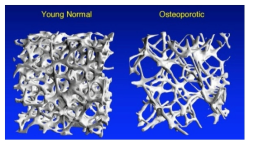 Trabecular degradation due to osteoporosis