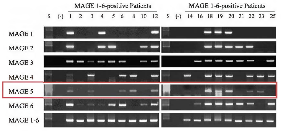 암 환자 25명의 암 조직 검체에 대해 MMRPs를 사용하여 nested-PCR 결과물 검출 효율성에 대한 전기영동 결과