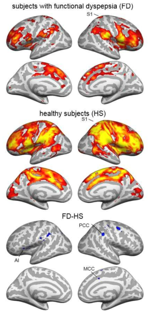 상복부에 가압자극(DISF)으로 유도된 불편감에 대한 뇌활성도와 두 실험군 간의 차이