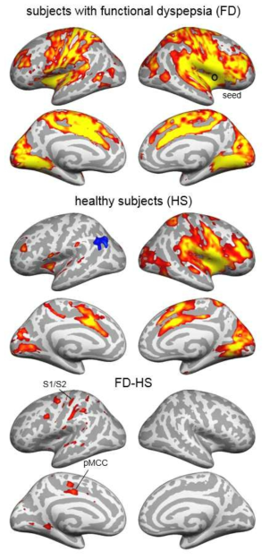 중간뇌섬(mid insula, 검은색 원으로 표시된 영역)의 기능적 뇌 연결성의 상태와 질환군과 비질환군 간이 차이