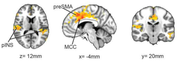 S1 seed의 기능적 뇌 연결성은 FD환자의 경우 지속적인 복부의 불편감이 유도된 상태에서 pINS와 MCC, preSMA와 증가함을 보임