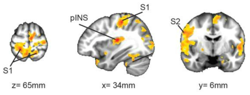 S1 seed의 기능적 뇌 연결성은 FD환자의 경우 지속적인 복부의 불편감이 유도된 상태에서 pINS와 MCC, preSMA와 증가함을 보임