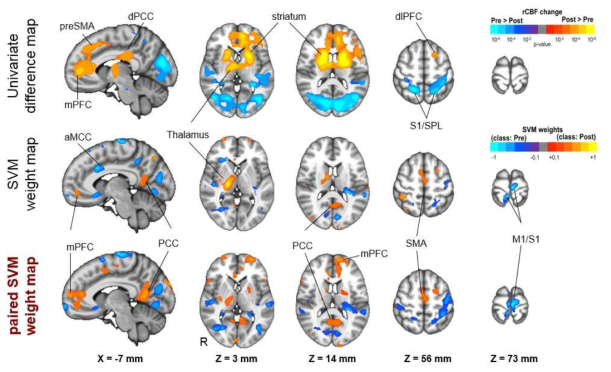 Maneuver 전후의 국소적 뇌 혈류량 차이(top)와 SVM을 통한 통증상태 분류지도(middle), paired SVM을 통한 분류지도(bottom)