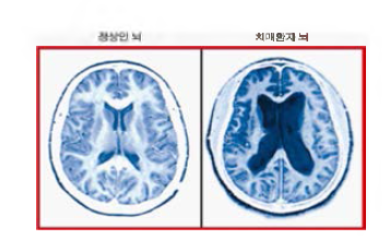 정상인과 치매환자 뇌 비교