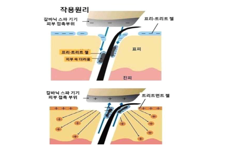 갈바닉 전류에 의한 노폐물 제거 예