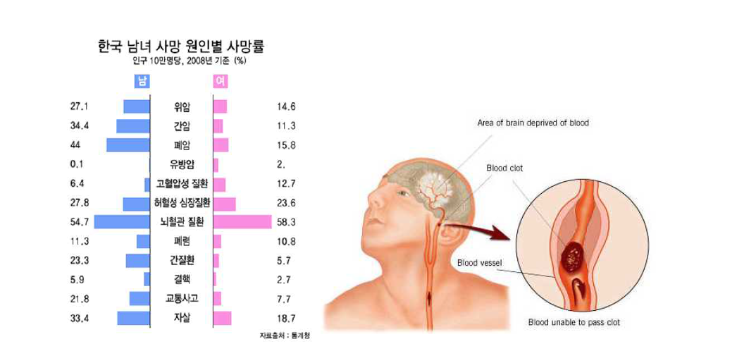 한국 남녀 사망 원인별 사망률(좌)와 뇌혈관 질환 설명도(우)