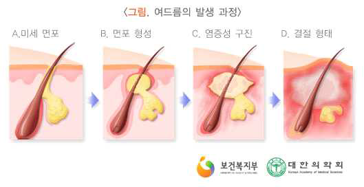 여드름 발생 과정 모식도