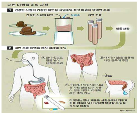 Fecal Microbiota Transplantation 과정