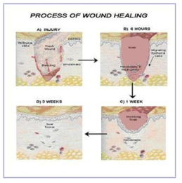 피부의 상처 치료과정