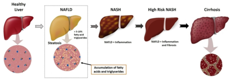 Spectrum of Nonalcoholic Fatty Liver Disease