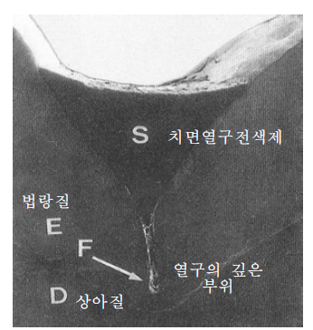 전색된 치아교합면의 단면