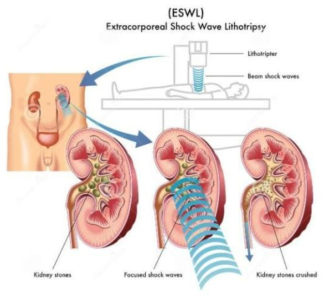 체외충격파쇄석기 치료과정