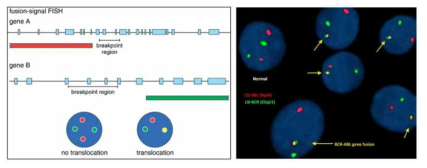 FISH를 이용한 translocation 검출 원리와 BCR/ABL 융합유전자 검출 결과