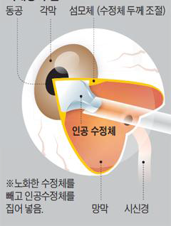 인공수정체 삽입술