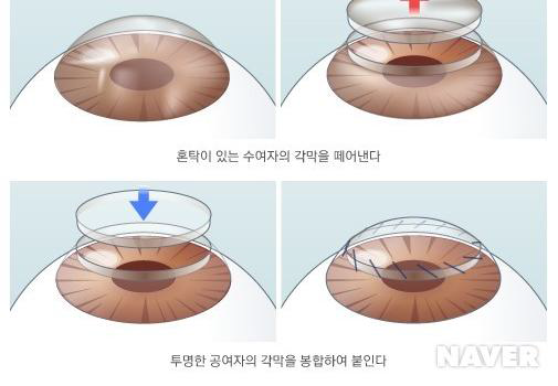 각막이식술