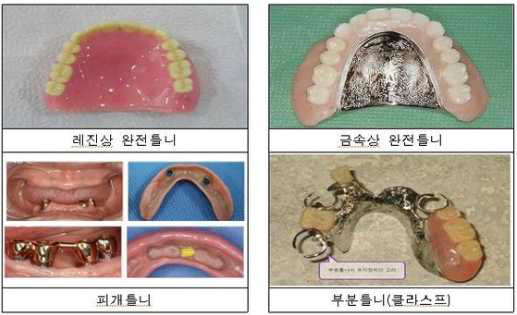 다양한 의치의 종류