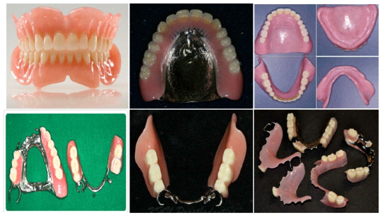 완전 의치 (위) 와 부분 의치 (아래)