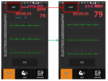 심전도 그래프 화면(좌: 양극유도, 우:단극유도)