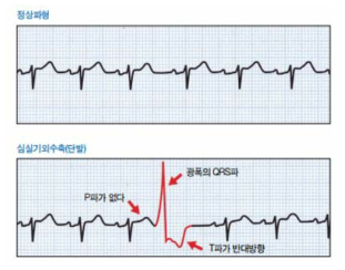 정상파형 및 심실기외수축(단발)파형