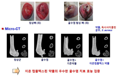 골수염 치료제로의 응용 사례