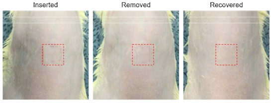 마이크로니들 패치 적용에 따른 피부 자극감 확인