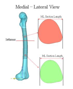 대퇴골 형상모델 기준 (Isthmus) 과 간부단면 측정 예