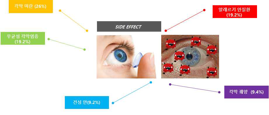 콘택트렌즈 부작용 안과질환 비율