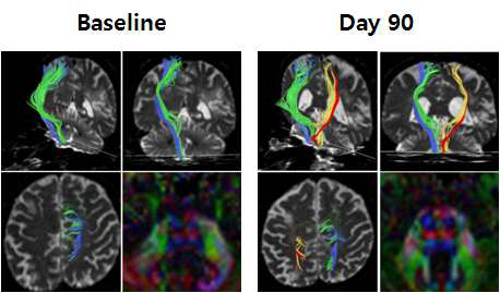 Serial diffusion tensor image (DTI) of patients who received MSC therapy