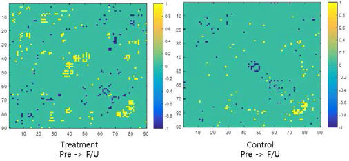 그룹 내 치료 전 후 whole brain network 연결 성 변화