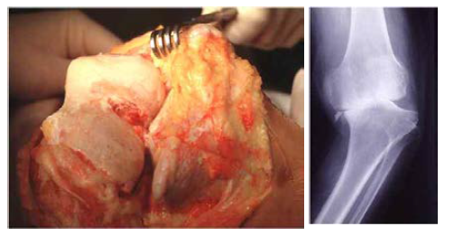진행된 골관절염의 수술소견(좌) 및 방사선 소견 (우).