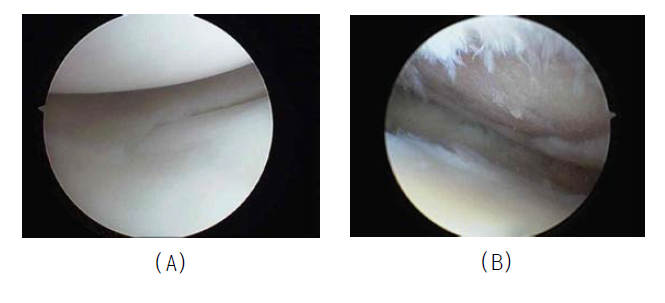 사람의 정상무릎관절(A)과 광범위한 연골 손상 무릎관절(B)의 관절경 사진