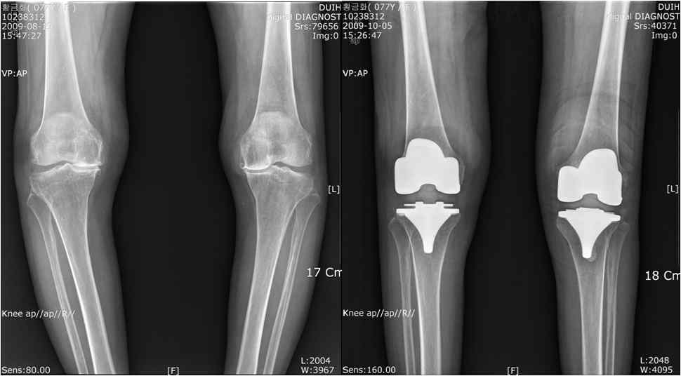 진행된 골관절염의 경우 시행하는 슬관절전치환술 (Total Knee Arthroplasty)