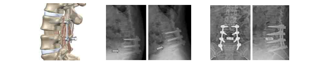 척추 고정술을 통한 척추 유합술 모식도 및 불유합으로인한 재유합술 시행