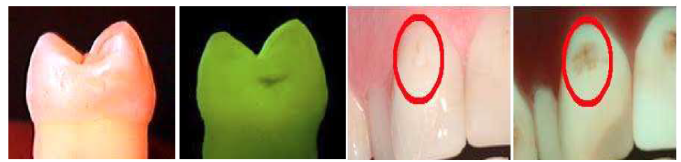 치아의 형광성을 이용한 치아우식증 탐지