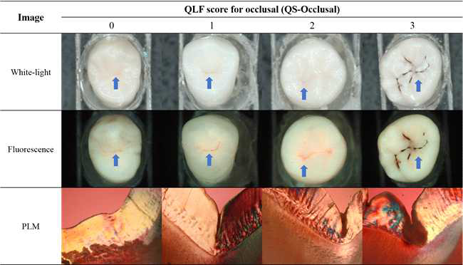 QS-Occlusal score에 따른 일반 영상, 형광 영상 및 편광현미경 영상.
