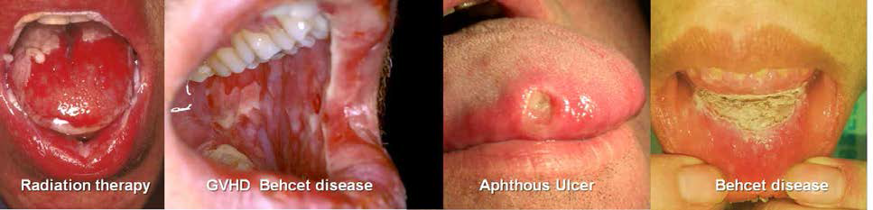 구강 궤양을 유발하는 다양한 질환군