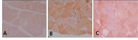 Immunohistochemistry of caspase-3 positive reaction in quadriceps muscle. A, Control group; B, Aging-elicited group; C, Gami-Shinkiwhan group