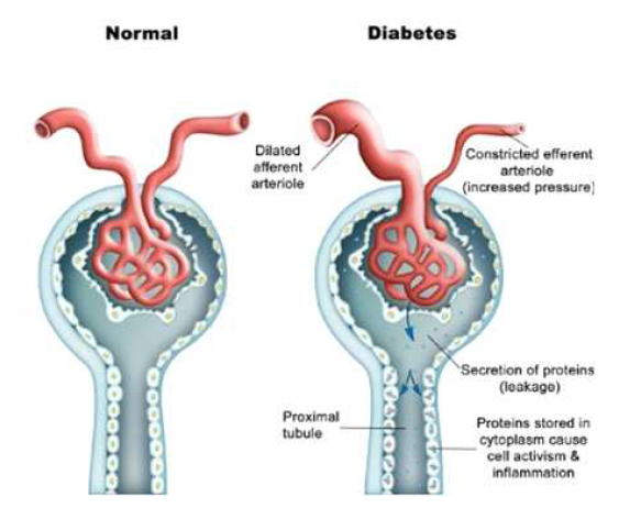 당뇨병성 신증의 세뇨관 염증반응