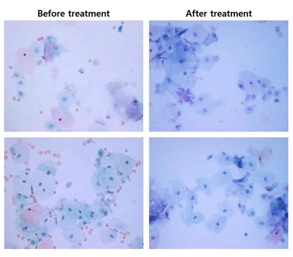 복용 12주 전후의 PAP staining 결과 사진 (위약군)