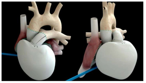 인공장기 예시(심장)