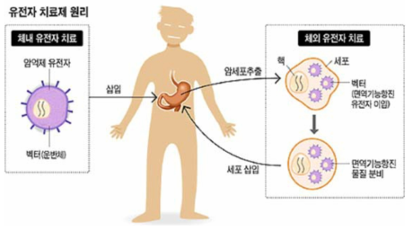 유전자 치료제를 활용한 치료법 예시