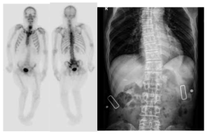 다발성 퇴행성 척추 질환 소견을 보이는 뼈 스캔 전, 후면부 사진(좌)과 척추 측만증을 보이는 척추 단순 방사선 사진(우)